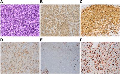 Clinicopathologic Features and Treatment of CD10-Positive Mantle Cell Lymphoma: A Case Report and Review of Literature